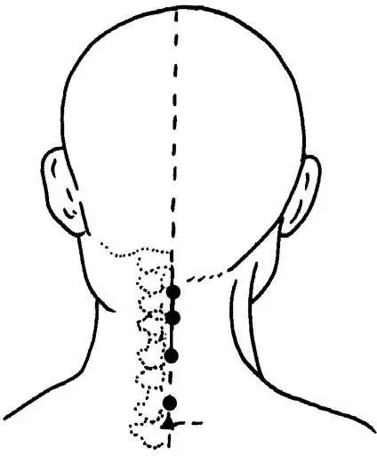 trinca cervical Ibrate.webp